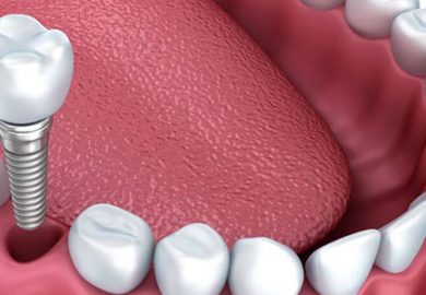 Diş İmplantı